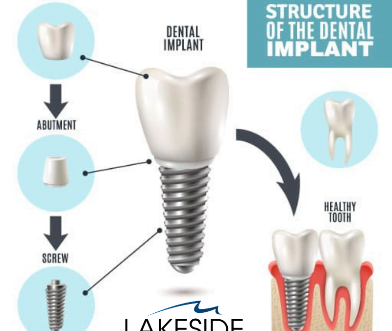 Dental Implants – The Gold Standard for Missing Teeth