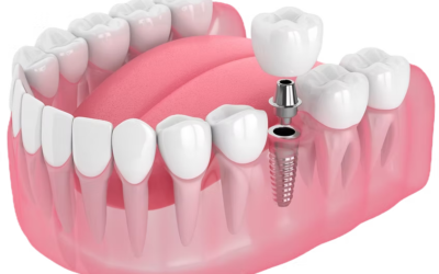Transitioning from Traditional Dentures to Stable Implant-Supported Restorations