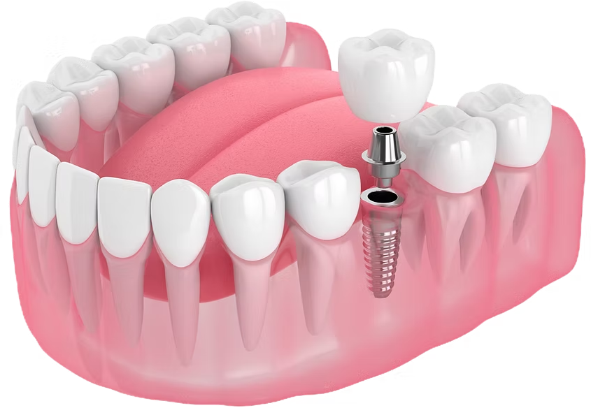 Dental implants
